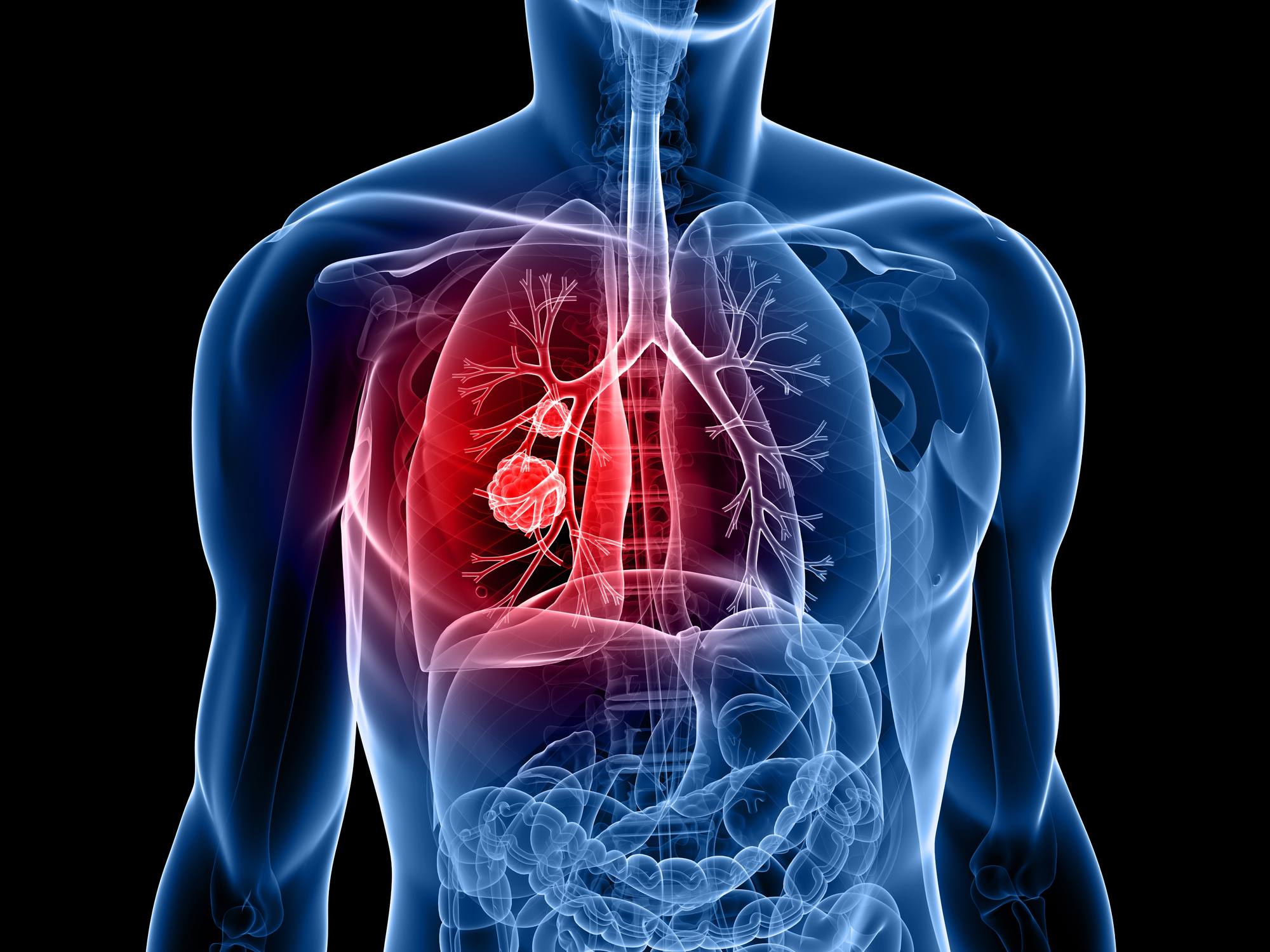 lung cancer